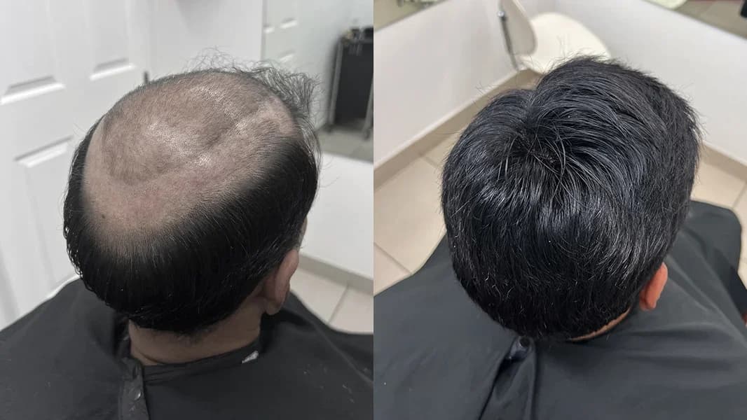 Top view before and after hair replacement