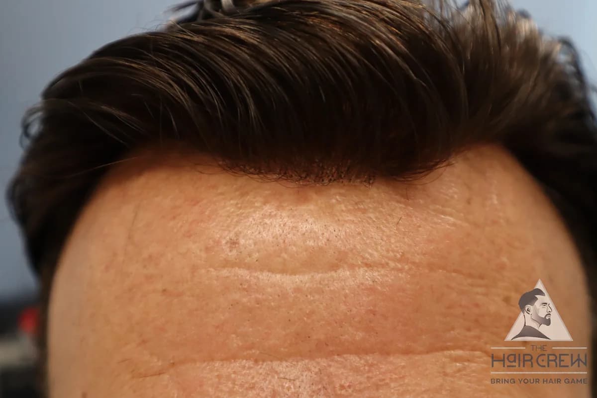 Close-up of a natural-looking hairline on a Hair Crew hair system