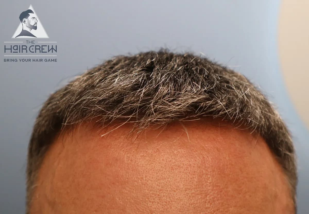 Front view of a client short, natural-looking hair system