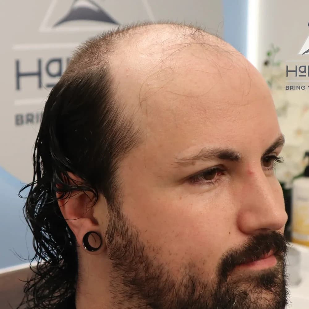 Before: Hair Crew client's hair replacement transformation