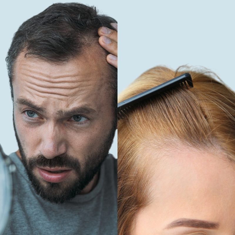 understanding-hair-loss-in-men-and-women