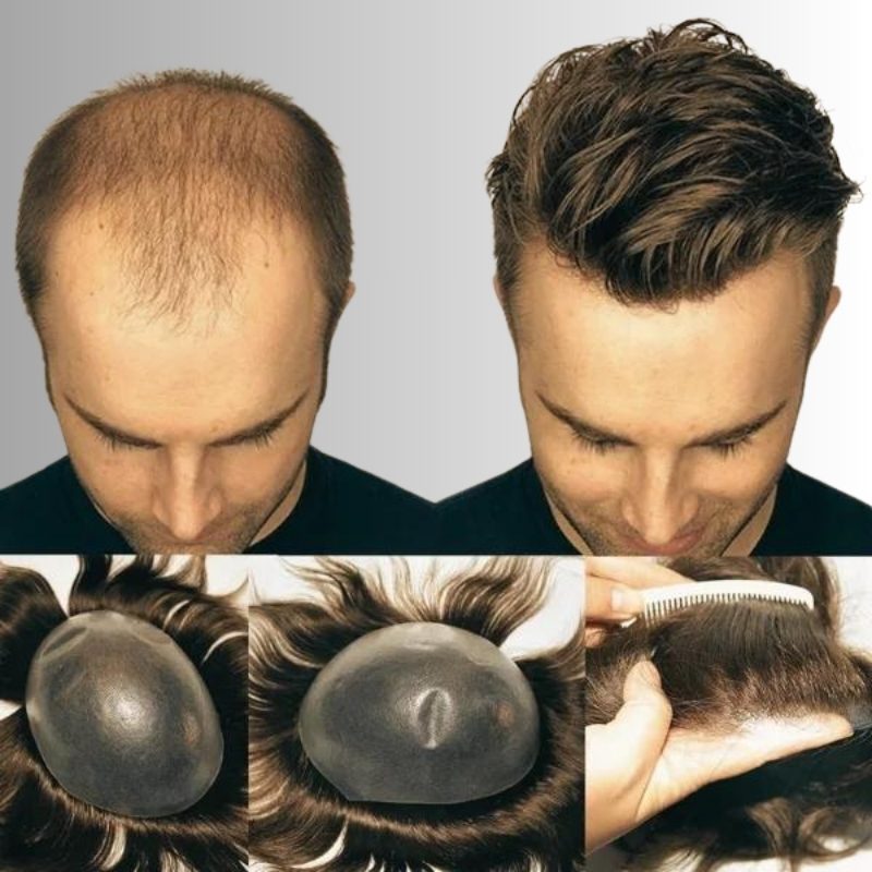 Complete Head Hair Replacement System The Hair Crew